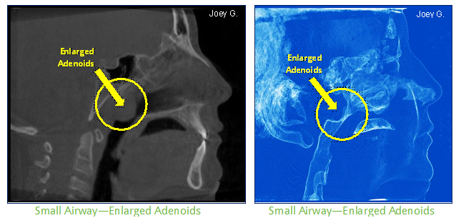 Airway small.jpg